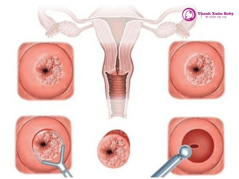 nhiễm trùng trong tử cung gây ra tình trạng nước ối bị đục