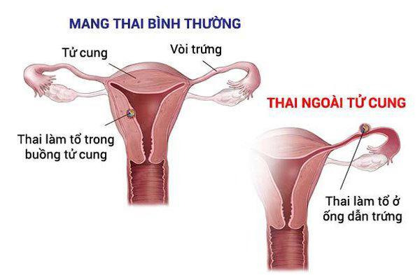 mang thai ngoài tử cung