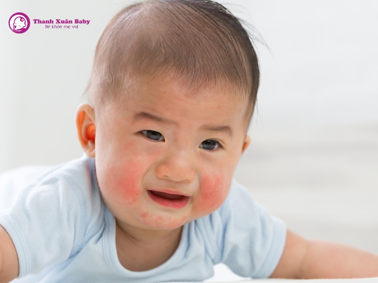 bé bị mề đay khi dị ứng sữa công thức