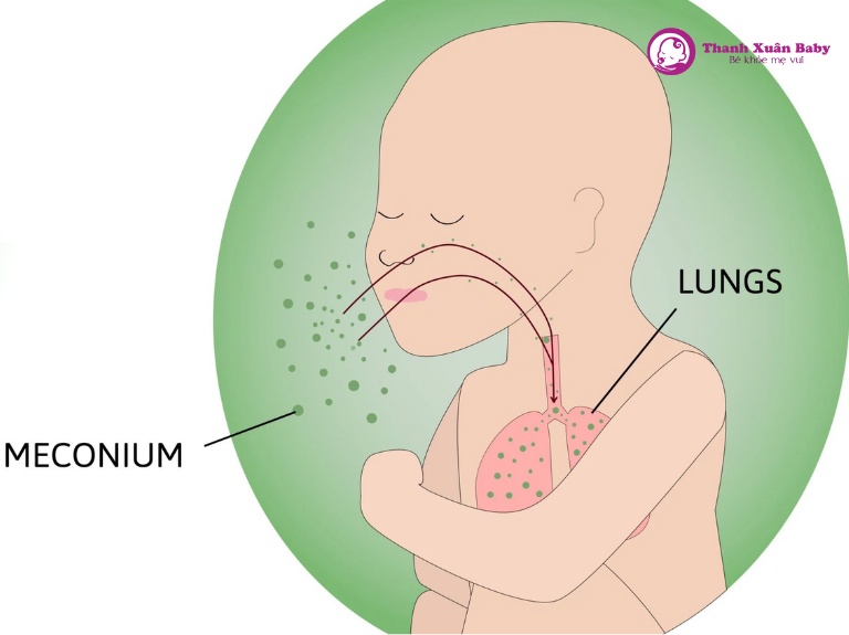 thai nhi thải phân su làm cho nước ối đục