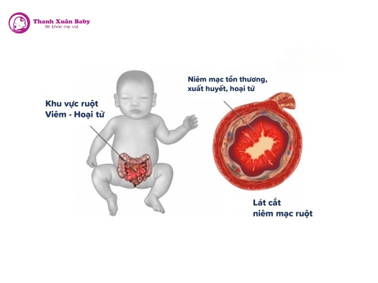 sữa công thức có thể gây tổn thương niêm mạc ruột của trẻ