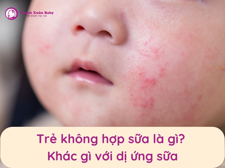 Trẻ không hợp sữa là gì