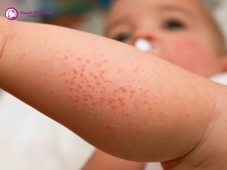 trẻ không hợp sữa dễ bị phát ban